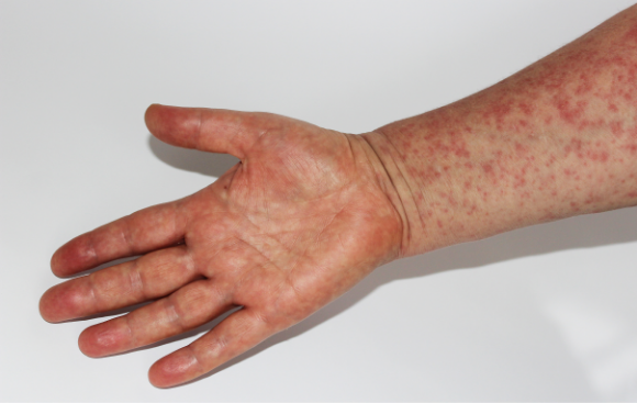 אחת המחלות שחוזרת הכי מהר ברגע ששיעור ההתחסנות באוכלוסייה צונח. פריחה אופיינית לחולי חצבת | צילום אילוסטרציה: Lolapetrova, Shutterstock