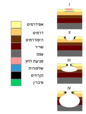 מהם פצעי לחץ? אורלי