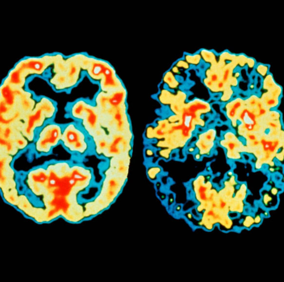 מדע בדקה: אלצהיימר בעקבות פגם בהתפתחות