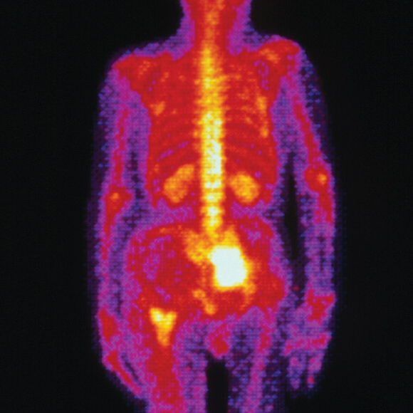 מחסור באיזוטופ נדיר עומד לסכן את בריאותם של מיליונים