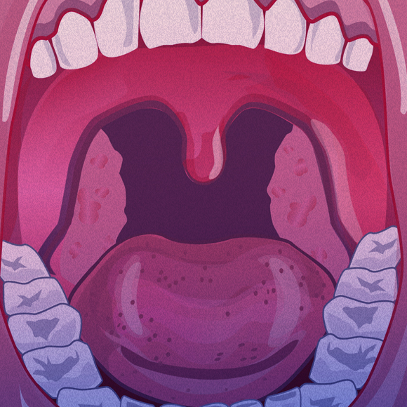 מחלות המעיים של חיידקי הפה