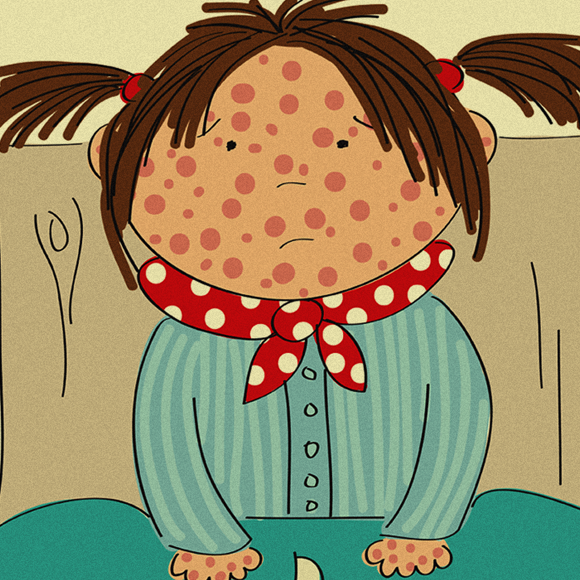 חצבת – האם זה באמת כל כך נורא? (כן)