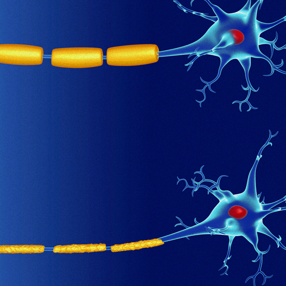 Among the Causes of Multiple Sclerosis: Heat and Salt