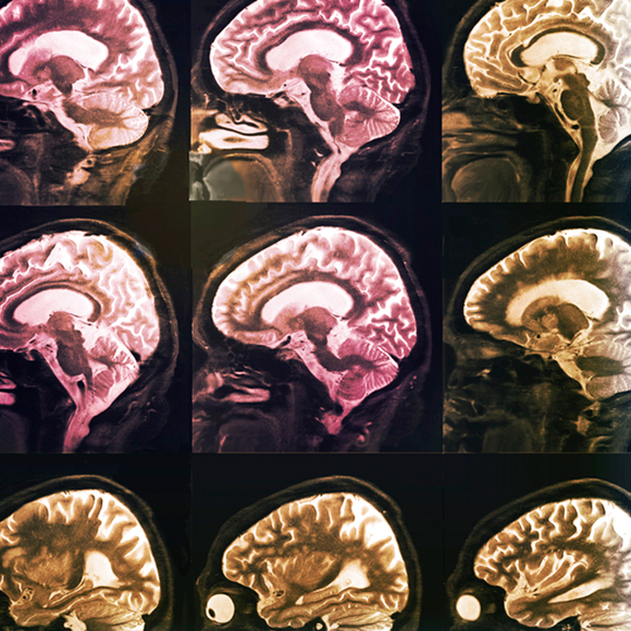 אפשר להידבק באלצהיימר?