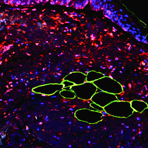The Fat that Awakes Cancer