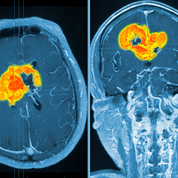 התאים הסרטניים המתחזים לעצבים