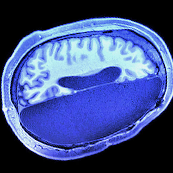 بحث يكشف: نصفُ دماغٍ كافٍ أيضًا