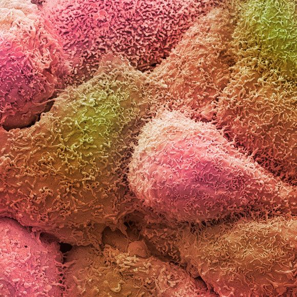 התאים שצועדים עם הגידול הסרטני