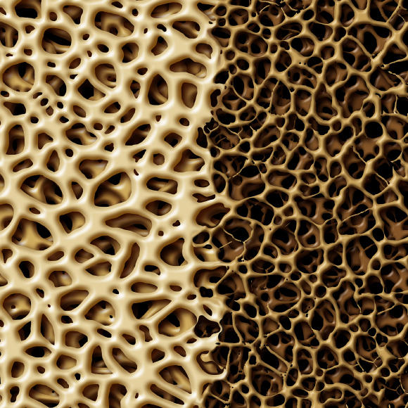 عندما تتفتّت العظام