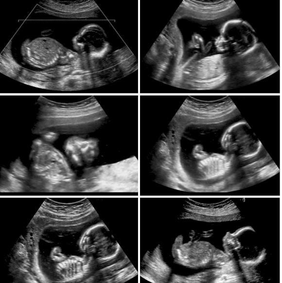 الطبيب الذي رأى الجَنين