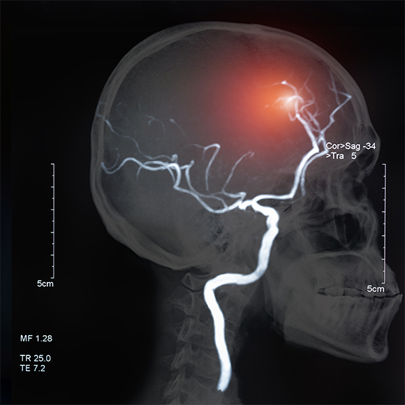 Understanding Stroke: Types, Symptoms, and Treatments