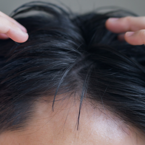 هل تضرُّ الشمس الرأس الأصلع؟