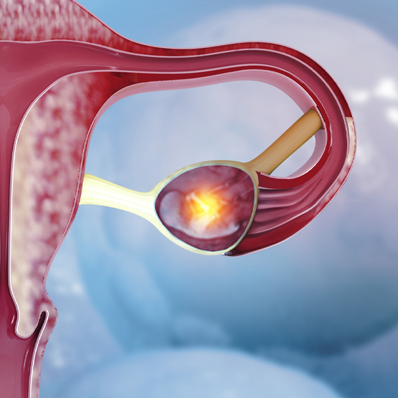 وِلادة مفاجِئة