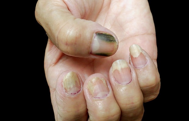 גם להפחתת תדירות המריחה יכולות להיות השלכות, בייחוד כאשר הציפורן למודת הטיפולים כבר נחלשה. זיהום חיידקי פסאודומונס בציפורן גרם לתסמונת הציפורן הירוקה | Richard Usatine Md / Science Photo Library