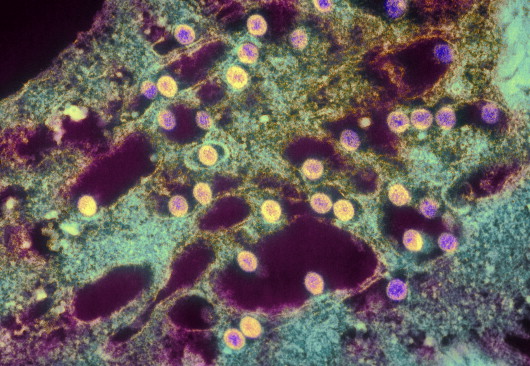 במקרים קשים עלולה המחלה להפוך לסוג של קדחת דימומית. נגיפי קדחת השבר הסורי-אפריקאי (בצהוב) | London School Of Hygiene & Tropical Medicine / Science Photo Library