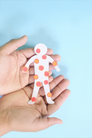 מחלות ללא גבולות: חצבת וקדחת השבר הסורי-אפריקאי