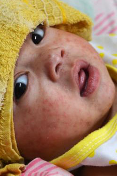 מחלות ללא גבולות: חצבת בארץ, שעלת בארצות הברית