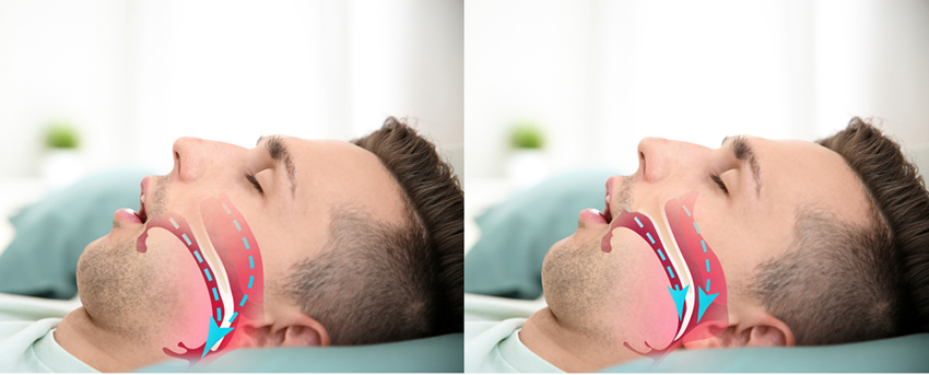 השילוב בין התרופות יוצר סינרגיה: אטומוקסטין מגבירה את מתח השריר ומשיכת הלשון קדימה וארוקסיבוטינין מייצבת את הפעילות ומונעת תנודות לא רצויות. מימין אדם עם דום נשימה חסימתי בשינה ומשמאל נשימה תקינה בשינה | Pixel-Shot, Shutterstock