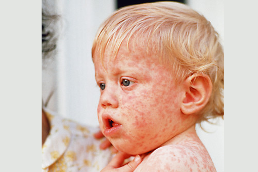 ההערכה היא שמספר החולים האמיתי גבוה בהרבה מהמספר הידוע. ילד עם פריחת חצבת | Lowell Georgia / Science Photo Library