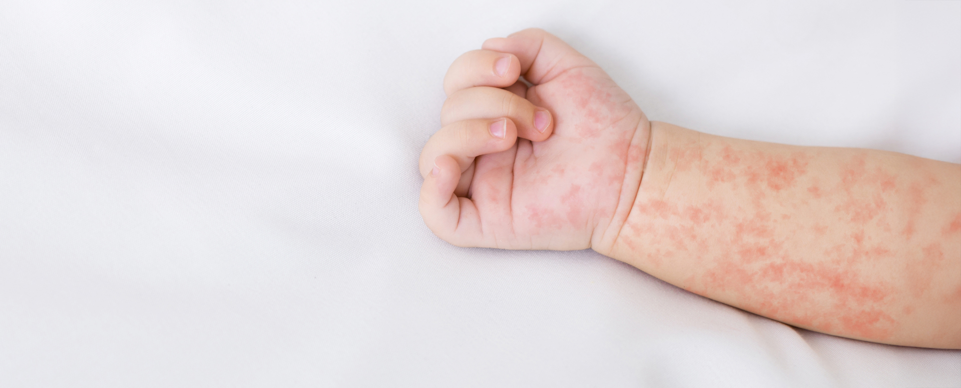 האם צריך להקדים את החיסון לחצבת?