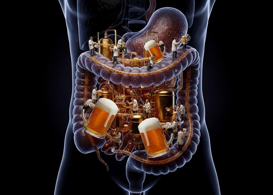 בתסמונת החיידקים מנתבים את הסוכרים למסלול פירוק שהתוצר העיקרי שלו הוא אלכוהול. מבשלת בירה בתוך מערכת העיכול | ליאת פלי באמצעות ג'מיני