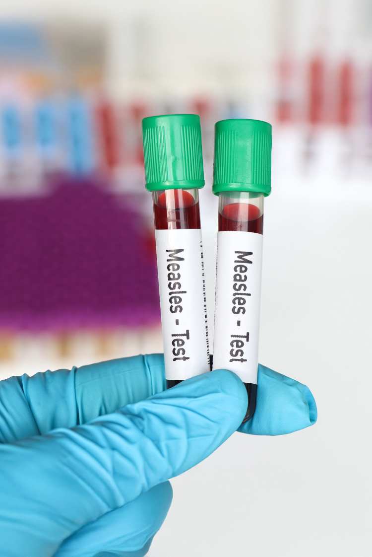 מחלות ללא גבולות: חצבת כאן, חצבת שם