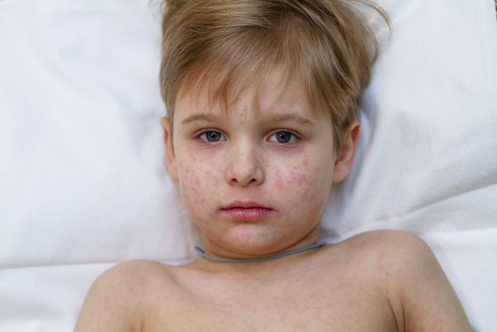 שיעור האשפוזים בעקבות חצבת גבוה במיוחד בישראל. ילד חולה חצבת | צילום: Maliutina Anna, שאטרסטוק