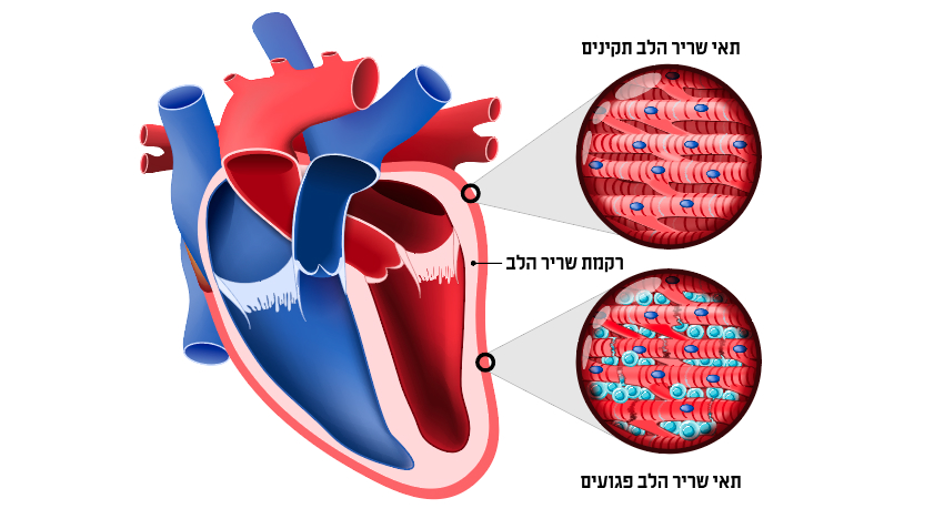 מתבטאת בכאבים בחזה, קוצר נשימה ותחושה של דפיקות לב חזקות. דלקת שריר הלב | Designua, Shutterstock
