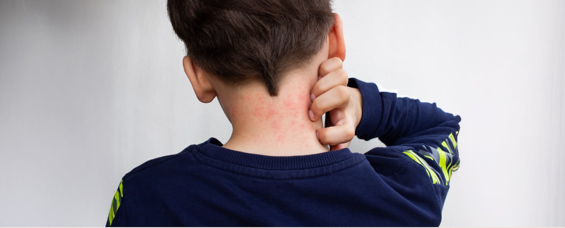 ילד עם פריחה על העורף | Janeberry, Shutterstock