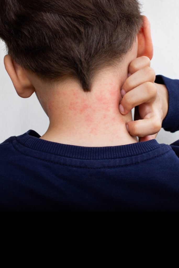 ילד עם פריחה על העורף | Janeberry, Shutterstock