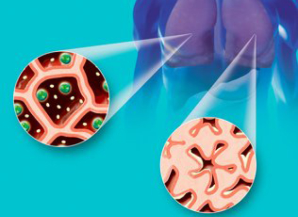 אילוסטרציה של הסימפונות באדם בריא (משמאל) ואצל חולה אסטמה, עם סימפונות צרות מאוד | Claus Lunau, Science Photo Library