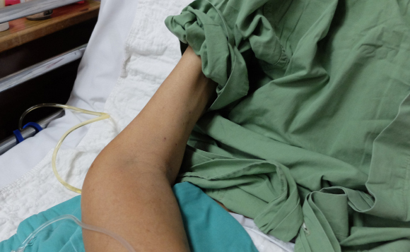 זרוע של אדם הסובל מכיחשון | Casa nayafana, Shutterstock 