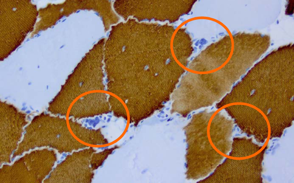 מראה רקמת שריר בחולה מיוטוניה דיסטרופית DM2