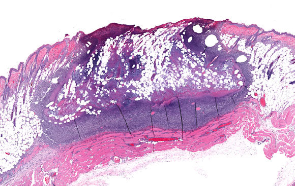 צילום במיקרוסקופ של זיהום עור בחיידקי סטפילוקוקוס | צילום: vetpathologist, Shutterstock