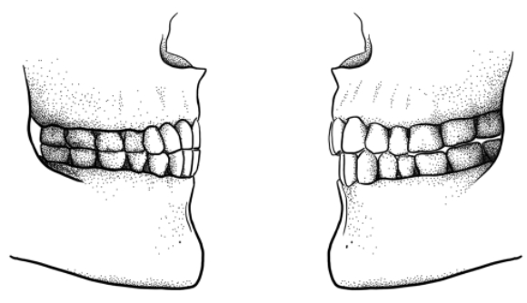 تغيُّر موقع الأسنان - الفكّين في العضّة التّراكبيّة (على يمين الرّسم)، مقابل فكّين على نفس الخطّ│الرّسم مأخوذ من: Tímea Bodogán, University of Zurich