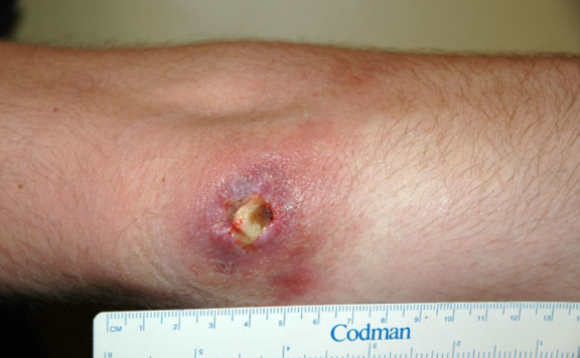 כיב בורולי במרפק של גבר בן 32 מאוסטרליה | מקור: Lavender et al