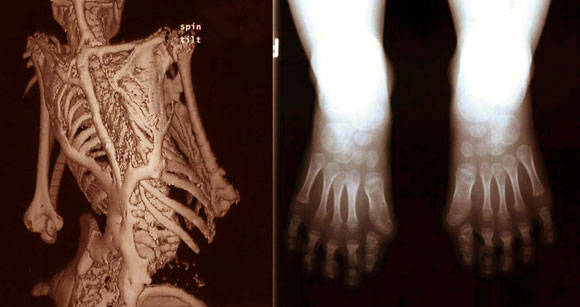 המחלה מתחילה בבהונות מעוותות ומסתיימת בשלד שני שמונע מהחולים לאכול ולנשום. צילומים מתוך מאמר על FOP