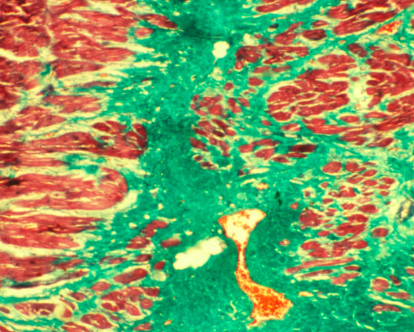 הדלקת שמשאירה צלקת. רקמת שריר הלב לאחר התאוששות מהתקף לב | מקור: Science Photo Library