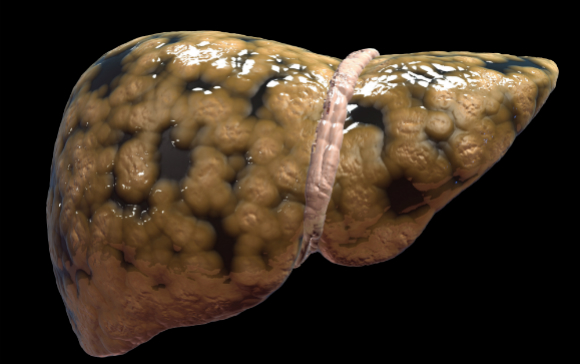 עודפי הפרוקטוז גורמים להצטברות שומן בכבד, כמו במצב של צריכת אלכוהול מופרזת. כבד שומני | צילום: Shutterstock