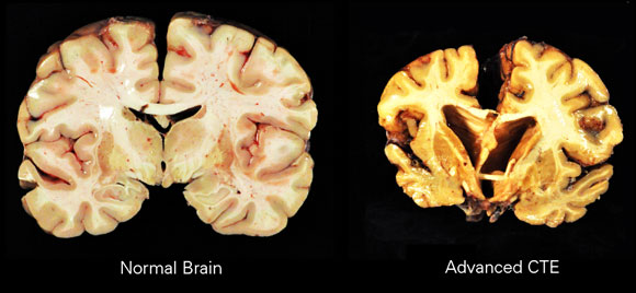 הצטברות של חלבונים מזיקים והרס של תאים. הדמיה של מוח של חולה CTE (מימין) לעומת מוח רגיל | מקור: ויקיפדיה